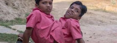 印度连体兄弟【被当地人奉为“神灵象征”】 – 人物百科