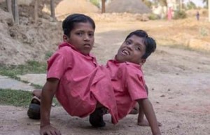 印度连体兄弟【被当地人奉为“神灵象征”】 – 人物百科