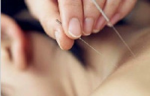 中医针灸有什么理论？中医针灸的方式_民间艺术 菊江历史网