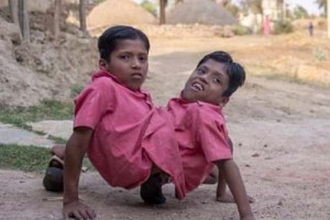 印度连体兄弟【被当地人奉为“神灵象征”】 – 人物百科